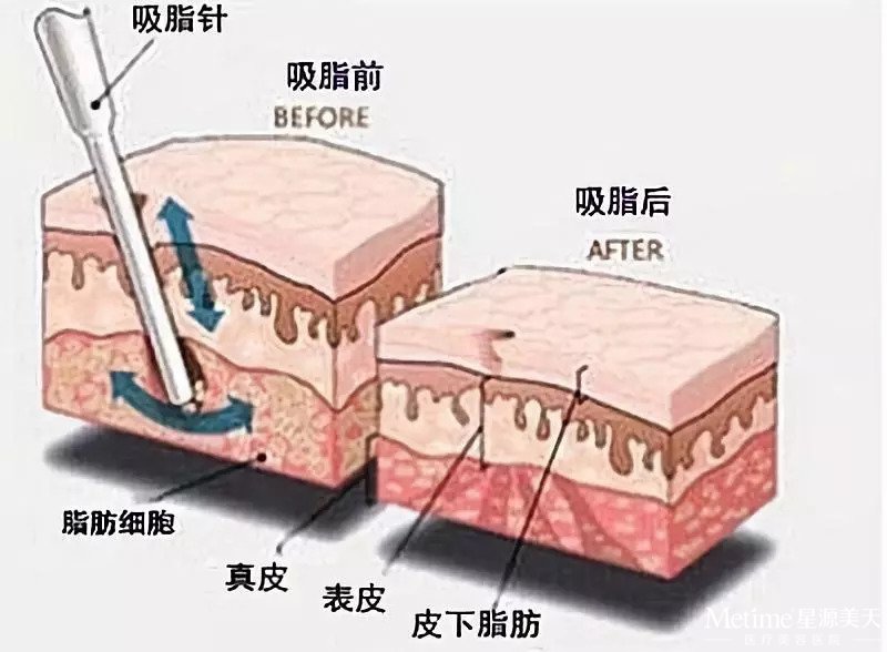 腰腹部吸脂减肥