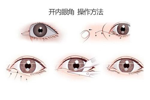 手术开眼角