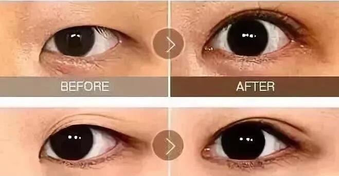 手术开眼角