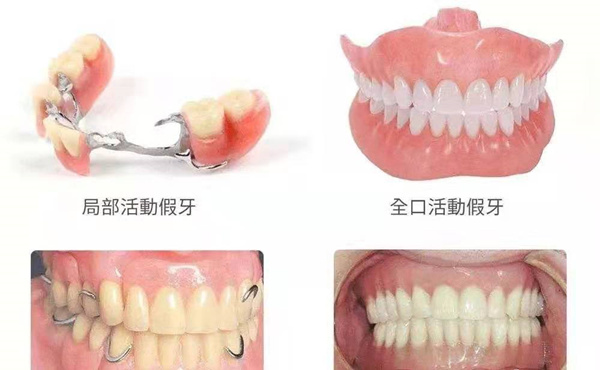 活动义齿
