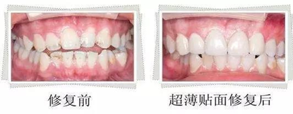 美学修复