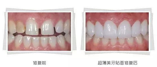 美学修复