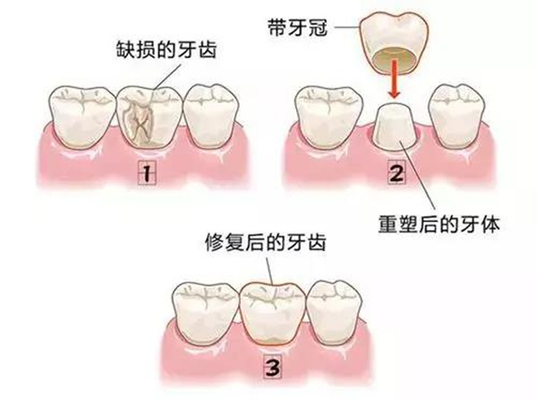 美学修复