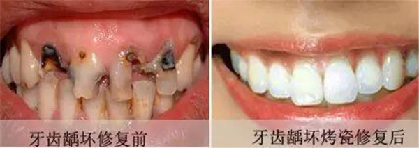 牙齿美学修复