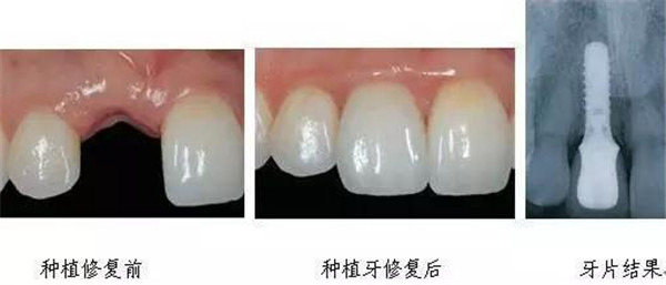 牙齿美学修复