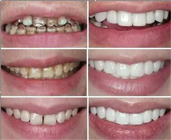 什么是牙齿美学修复