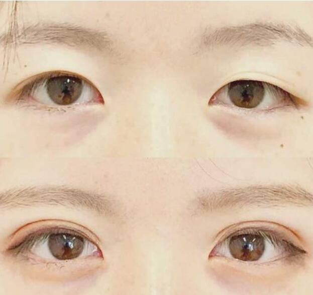 新乡哪些人适合做无痕双眼皮?