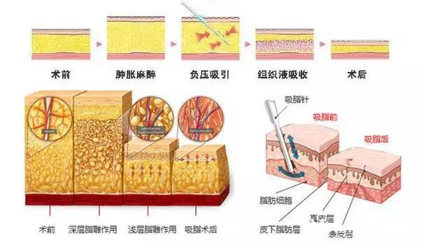 为什么新乡吸脂减肥不易反弹?