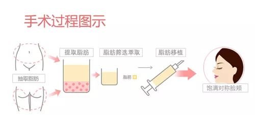 新乡自体脂肪填充美容