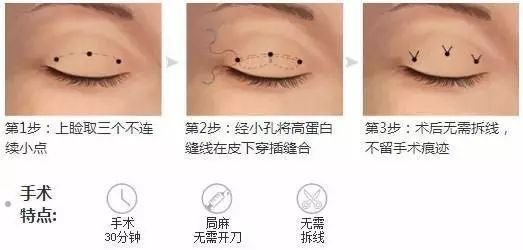 新乡无痕双眼皮效果