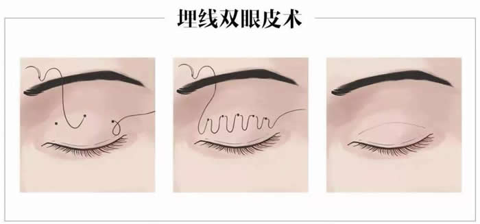 新乡做双眼皮要埋线吗？