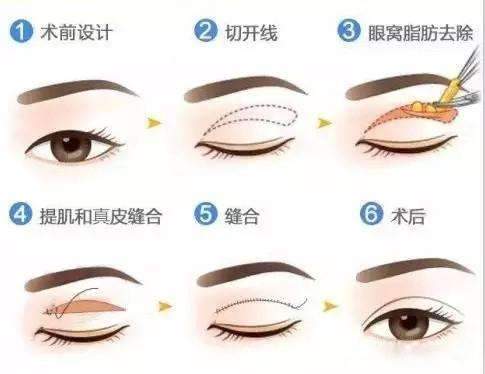 新乡做双眼皮要埋线吗？