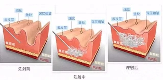 新乡美容 除皱