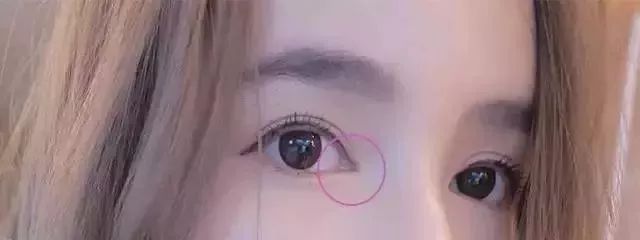 新乡做开眼角电话
