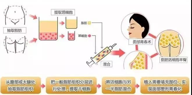 1576637767853829.jpg 自体脂肪
