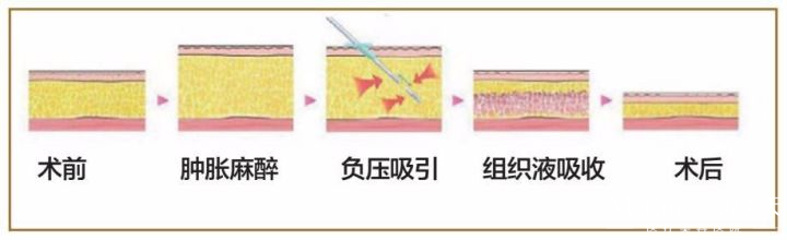 新乡吸脂减肥