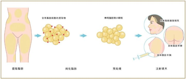 新乡吸脂减肥