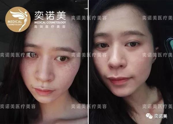 “一秒换肌肤” 蜂巢皮秒让你新年换新颜！