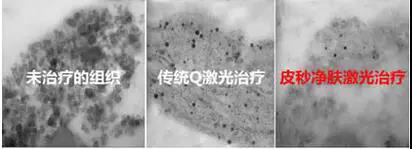 “一秒换肌肤” 蜂巢皮秒让你新年换新颜！
