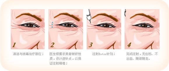 新乡除皱纹