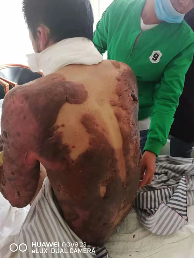 浓度、纯净度、小粒径的负离子恢复烧、烫的机理详述