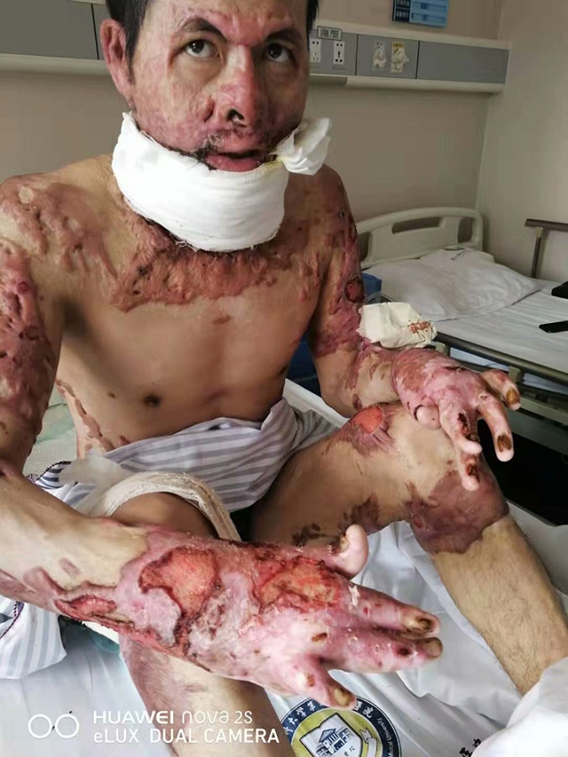 浓度、纯净度、小粒径的负离子恢复烧、烫的机理详述