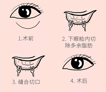 祛眼袋