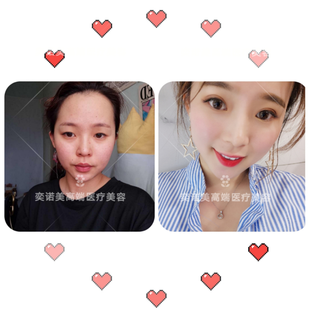 双眼皮