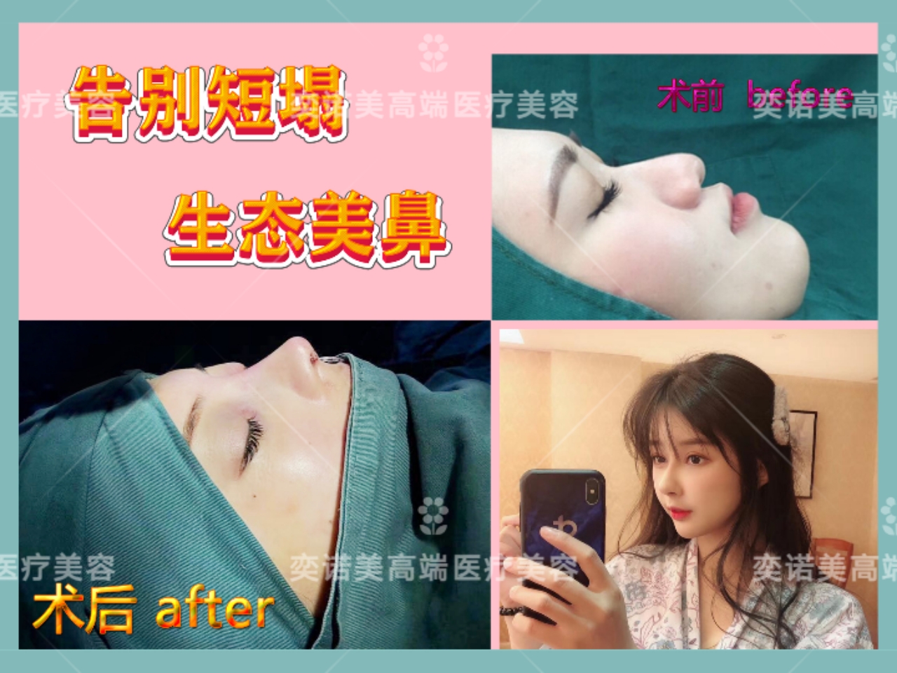 鼻综合