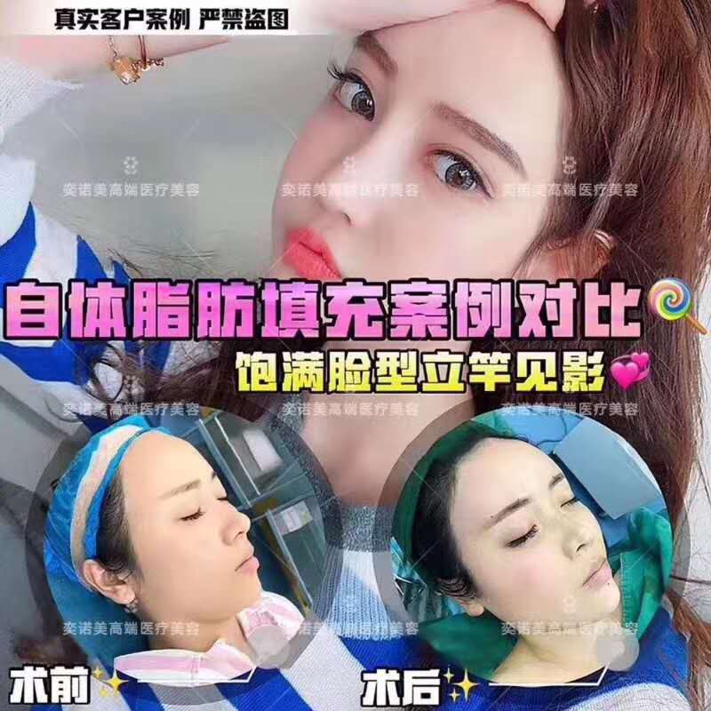 自体脂肪填充