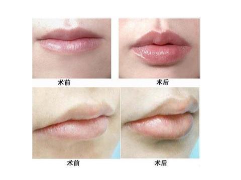 玻尿酸