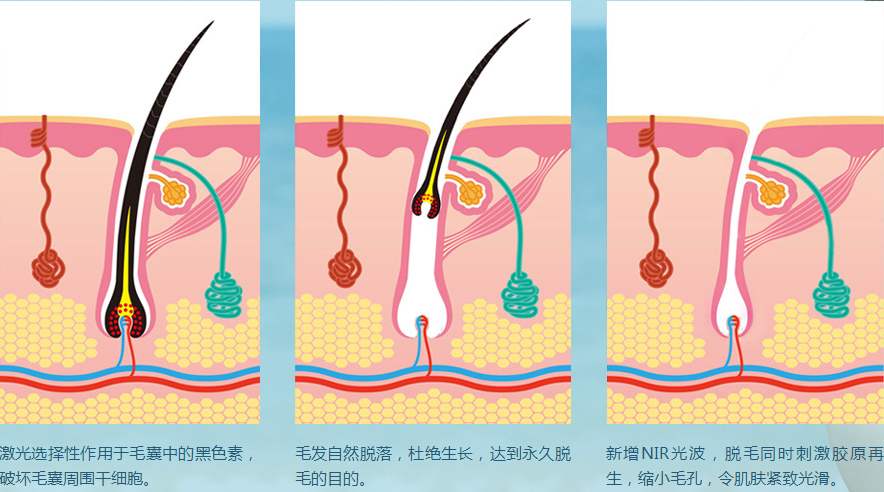 激光脱毛