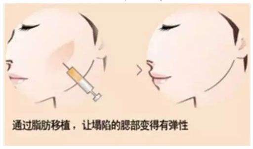 自体脂肪填充