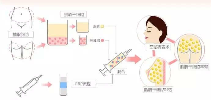 自体脂肪填充