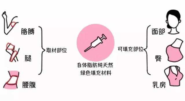 自体脂肪填充