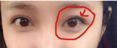双眼皮