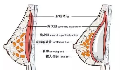 假体隆胸