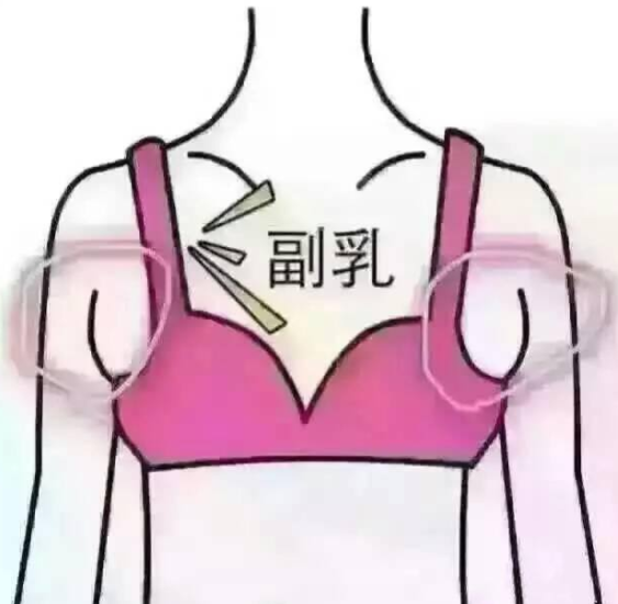 副乳