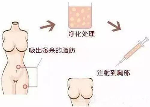 自体脂肪