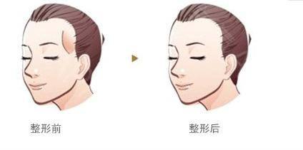 丰太阳穴