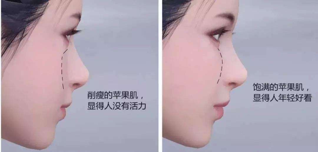 注射苹果肌