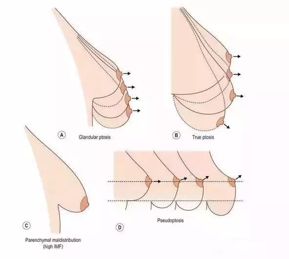 乳房下垂