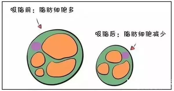 背部吸脂