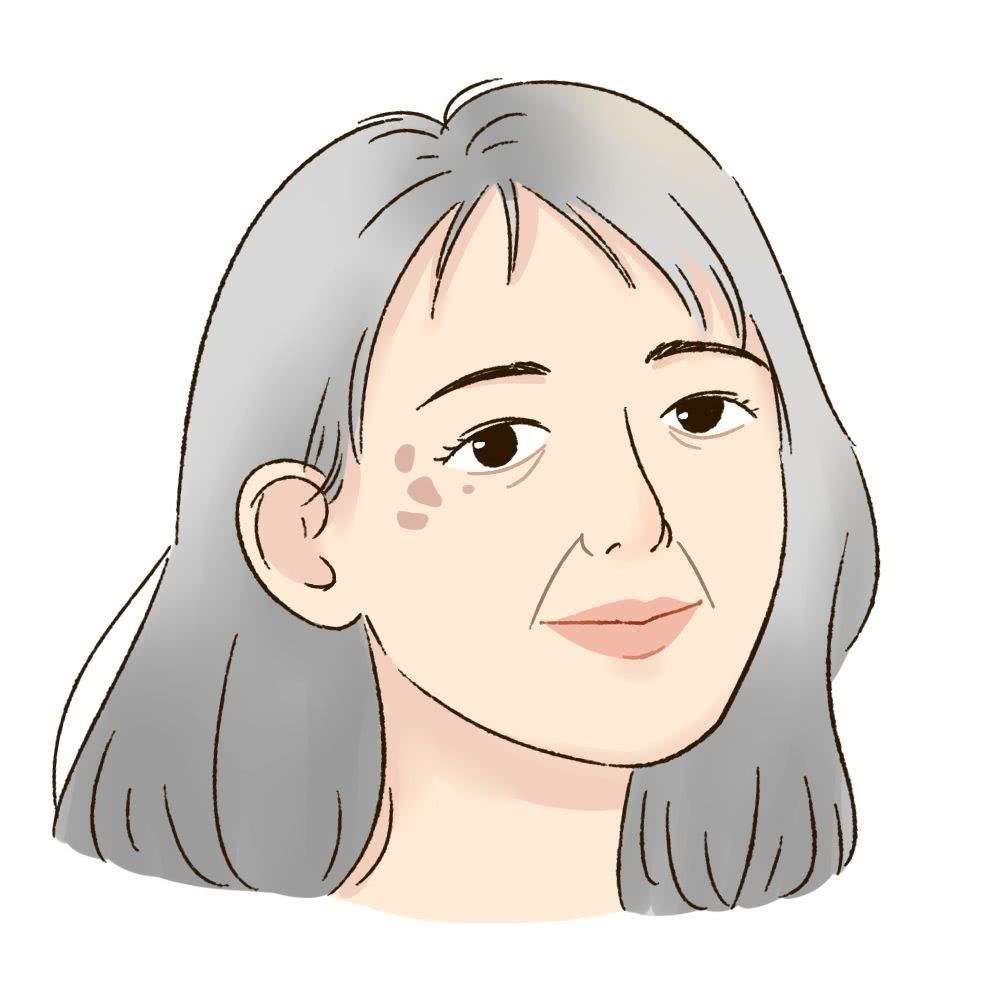 激光去斑