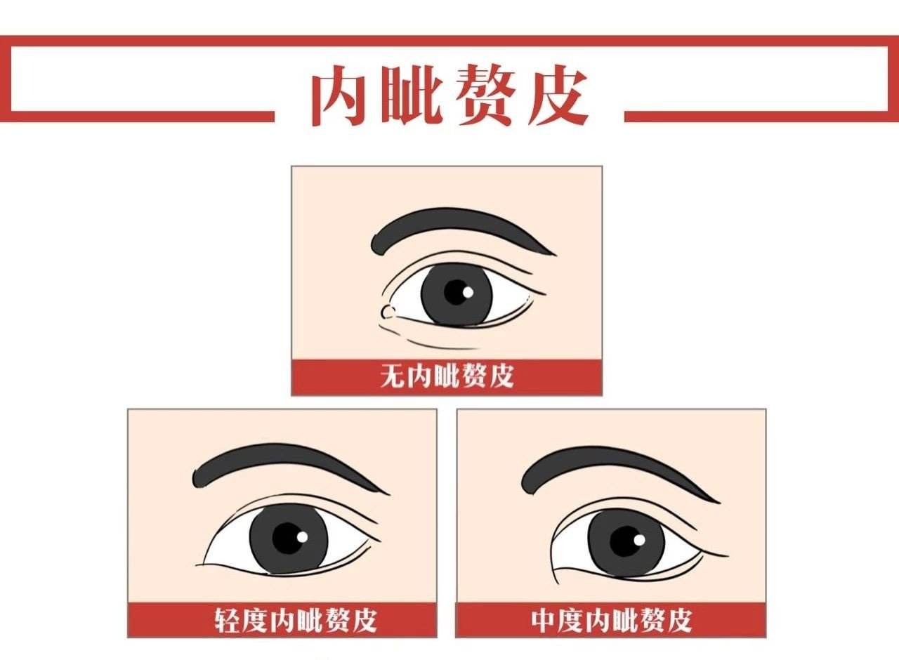 新乡开眼角
