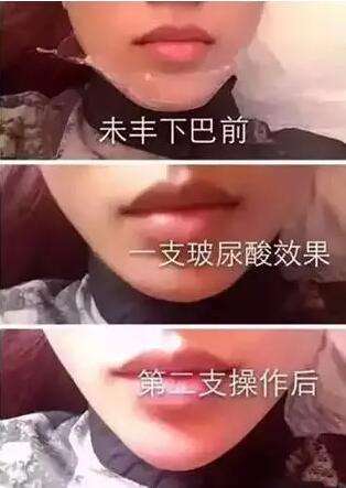 注射丰下巴