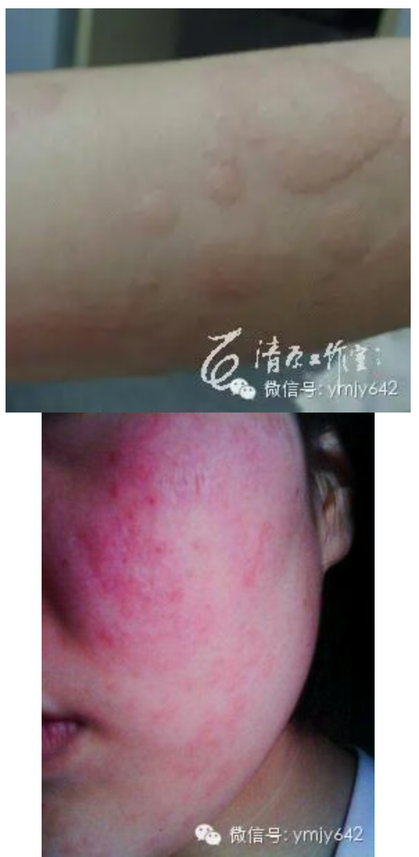 皮肤过敏