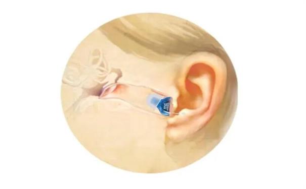盘锦耳道式助听器