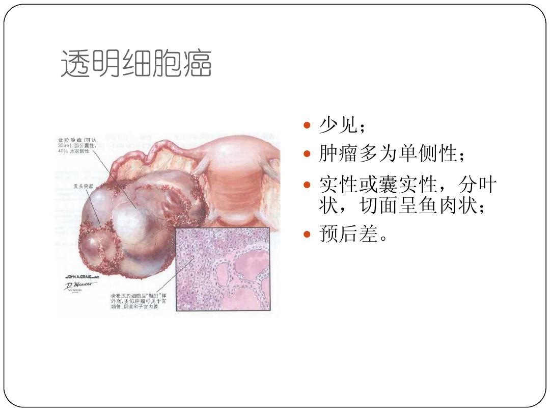 透明细胞癌