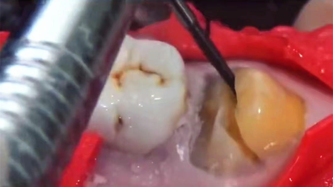 鲅鱼圈拔智齿